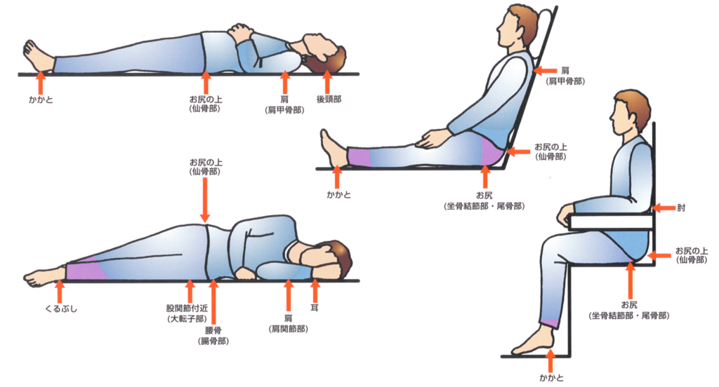 No.7 褥瘡預防｜姿勢調整與減壓照護技術